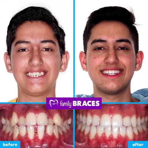Before and after orthodontic treatment result 10