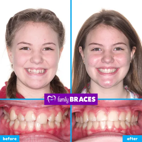 Before and after orthodontic treatment result 15