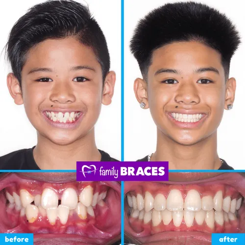 Before and after orthodontic treatment result 2