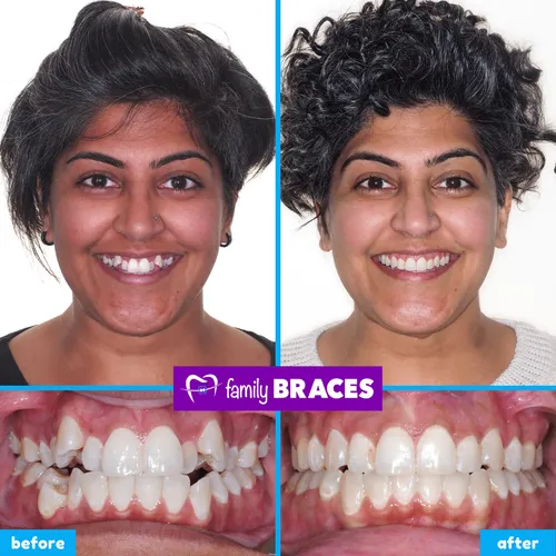 Before and after orthodontic treatment result 4