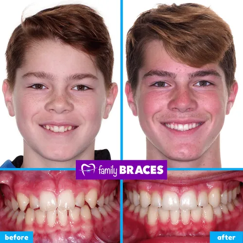 Before and after orthodontic treatment result 5