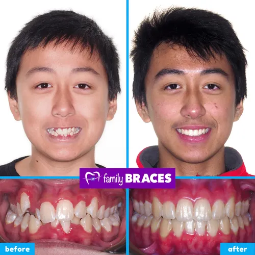 Before and after orthodontic treatment result 6