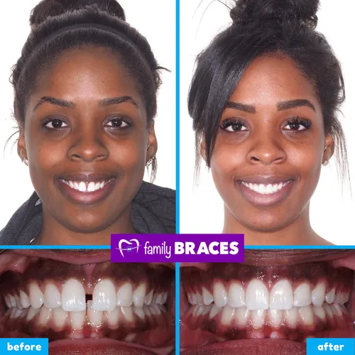 Before and after orthodontic treatment result 8
