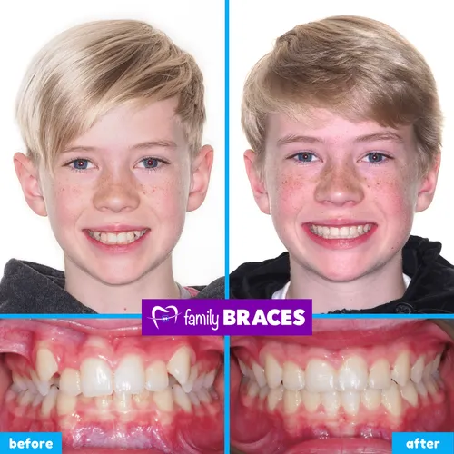 Before and after orthodontic treatment result 9